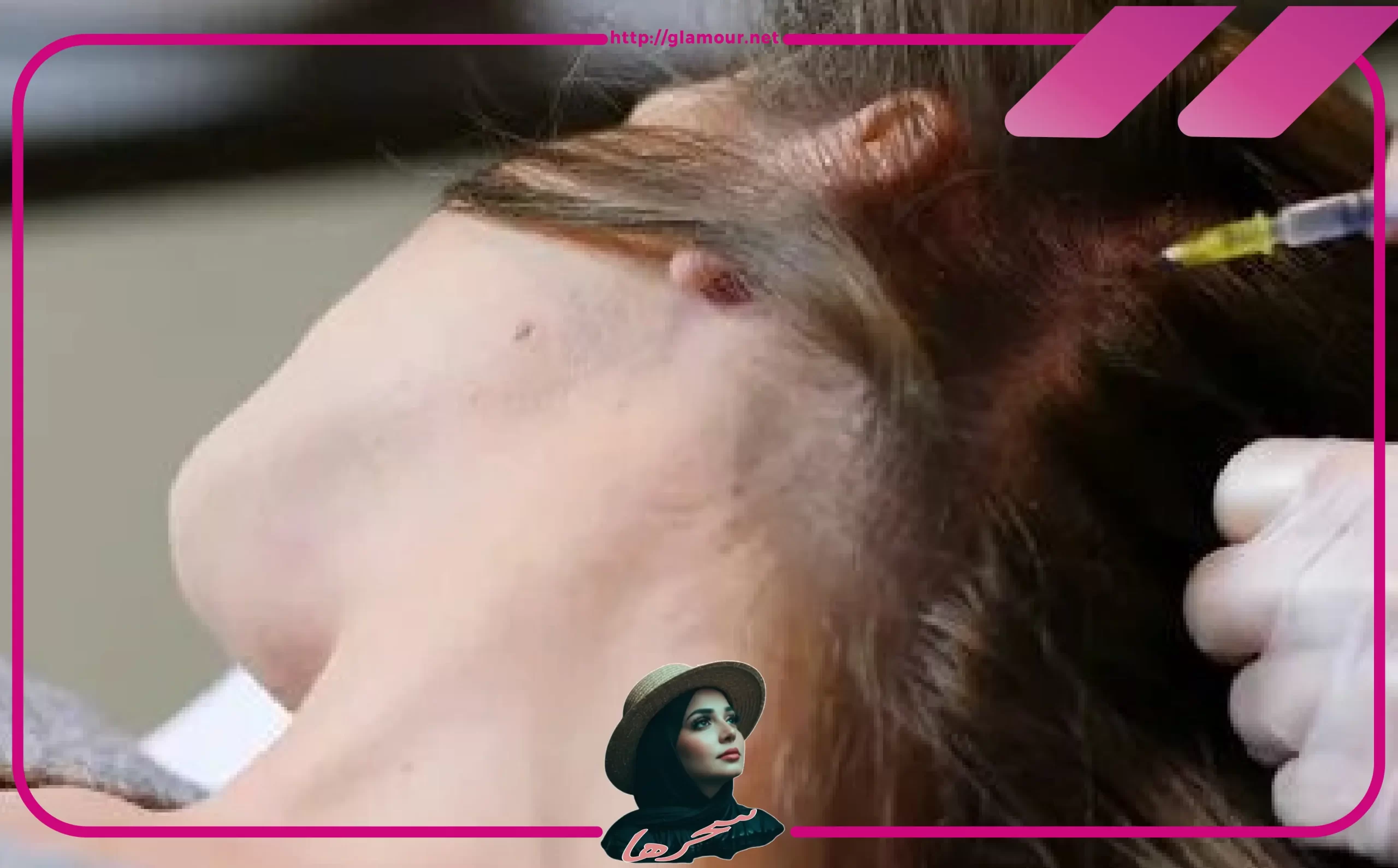 الميزوثيرابي للشعر