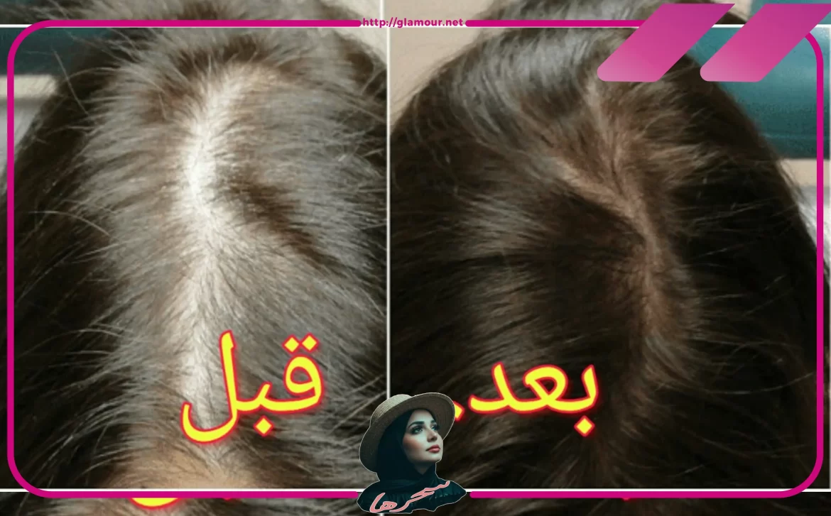 أحدث علاجات الشعر